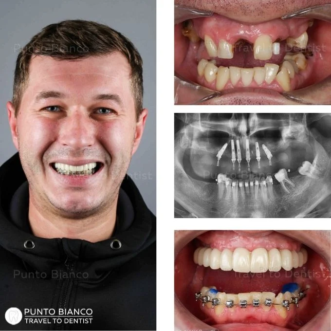 FP1 provisional prosthesis (without artificial gum) on 6 dental implants