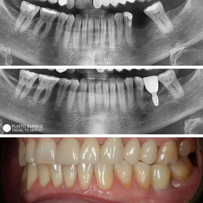 Implant Straumann Roxolid cu transplant de gingie și coroană din zirconiu, realizat în Moldova pentru un rezultat natural fără adiție osoasă