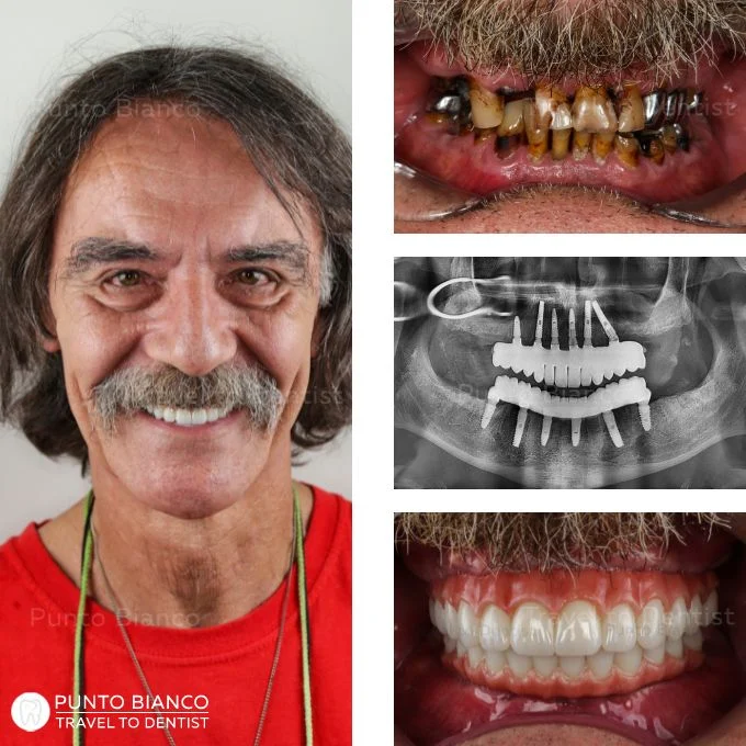 Înainte și după implant dentar toată gura în Chișinău.