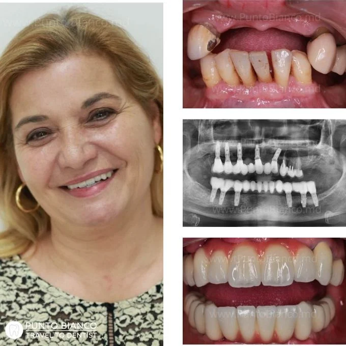 Reabilitare totală cu coroane și punți dentare pe dinți naturali și implanturi Chișinău