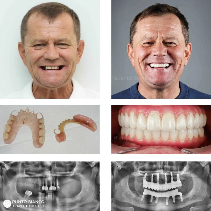 Complete dental rehabilitation in Moldova for a patient from Italy, from old removable dentures to fixed teeth on implants