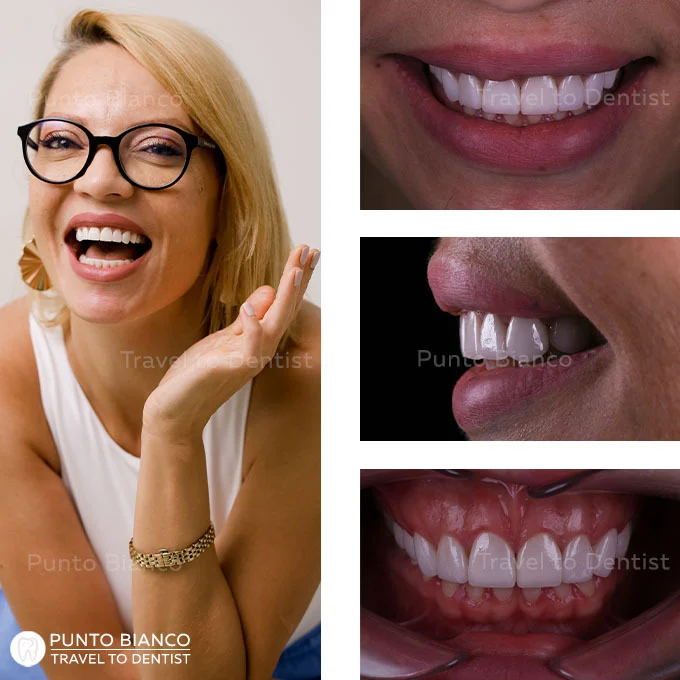Fotografii după fațete dentare în stil american realizate în Moldova.