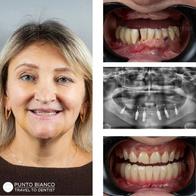 Patient from the diaspora, originally from Ukraine and living in Italy, treated in Moldova with fixed provisional teeth on mandibular implants within 24 hours