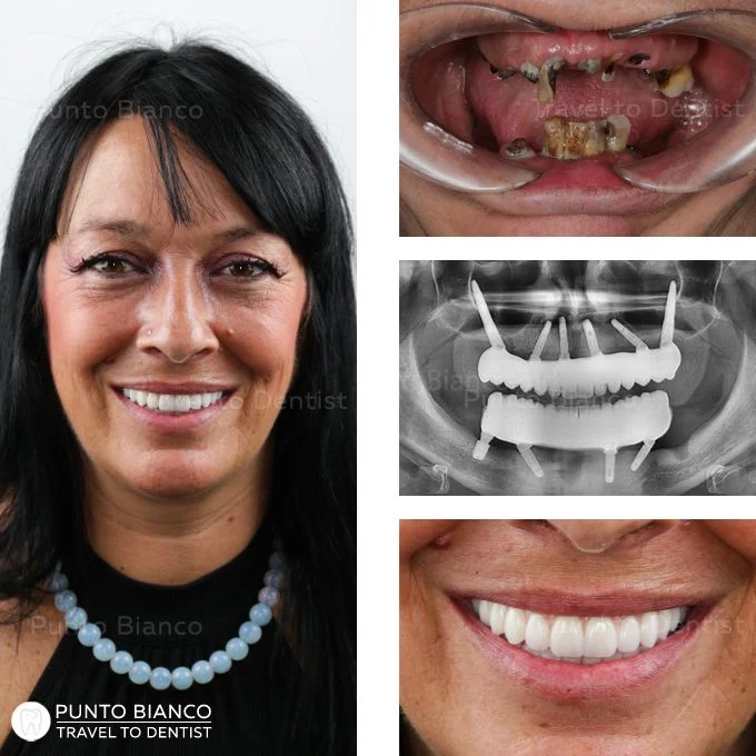 Înainte și după Dantură Fixă din zirconiu sus și jos pe implanturi tradiționale + speciale (2 implanturi zigomatice sus și un implant super scurt jos) realizat la Punto Bianco Chișinău