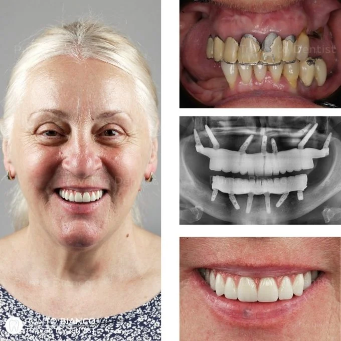 before and after total rehabilitation with special implants