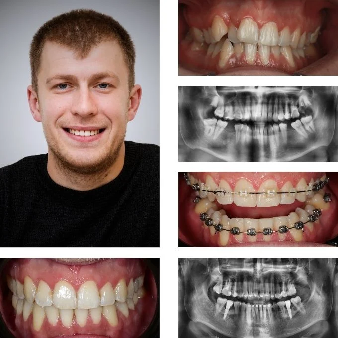 Tratament ortodontic cu bracketi, urmat de implanturi dentare și protezare, pentru corectarea înghesuirii dentare și refacerea spațiului pierdut