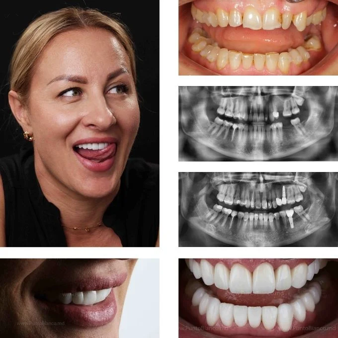 Reabilitare dentară estetică și funcțională în Chișinău, după alinierea dinților cu aligners, prin fațete și implanturi dentare