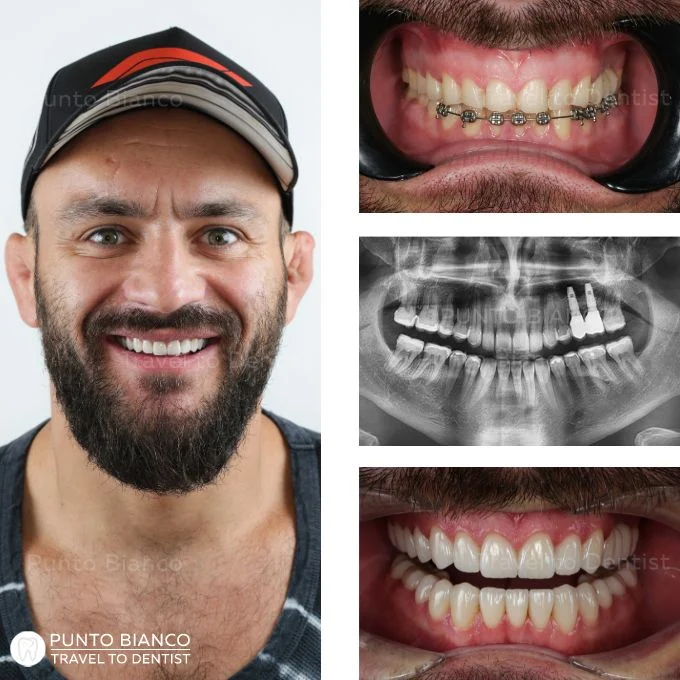 Colaj foto: Pacient fericit + radiografia de control + poze intraorale înainte și după reabilitare totală cu fațete dentare premium și implanturi în Moldova