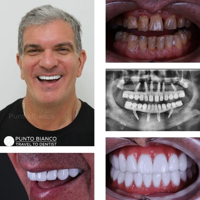 Reabilitare dentară premium în Moldova, cu All-on-6 sus și All-on-4 jos, realizată pe implanturi Nobel Biocare și proteză din zirconiu pe bară de titan