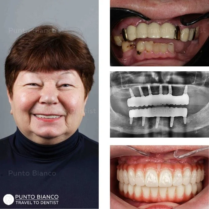 before and after images all on 6 implants in chisinau