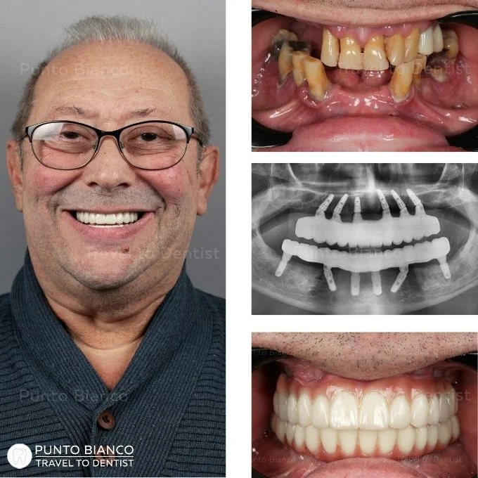 Complete dental rehabilitation in Moldova for a dental tourist from Israel, with fixed teeth on implants and no bone grafting
