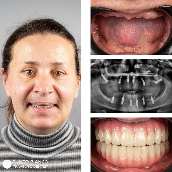 Colaj poze pacienta cu implanturi all-on-6 si proteze provizorii (portret, dinti inainte si dupa, radiografia cu implanturi)