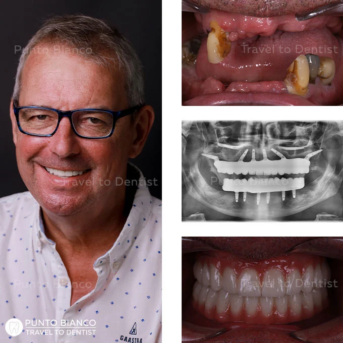 2 proteze fixe pe implanturi dentare All-on-6 cu utilizarea implanturilor pterigoide în Chișinau: foto înainte și după tratament