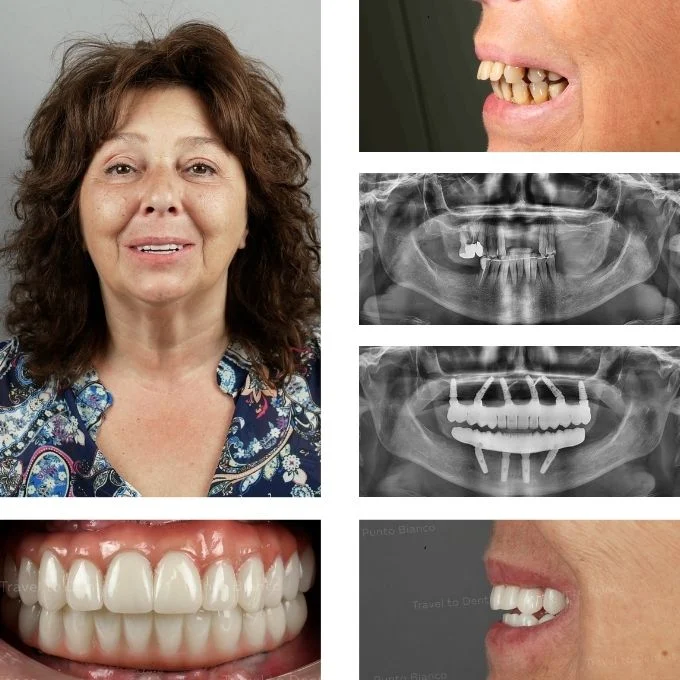 Complete dental rehabilitation in Moldova for a patient from Belgium, replacing partial removable dentures with fixed teeth on implants