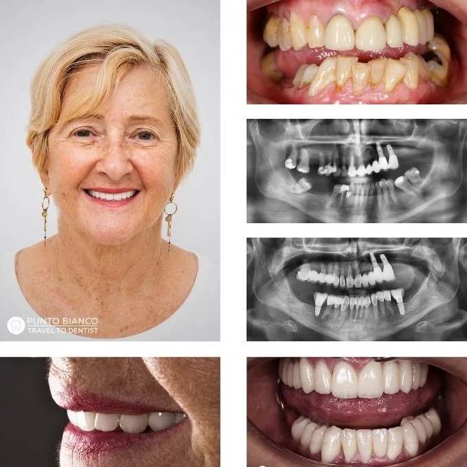 Reabilitare dentară complexă în Moldova, cu păstrarea majorității dinților naturali, implanturi dentare și restaurări din zirconiu și ceramică EMAX