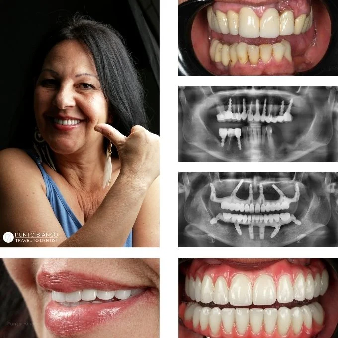 Complete dental rehabilitation in Moldova for a patient from France, with fixed teeth on implants<br>
