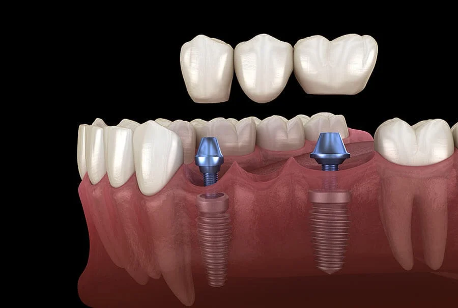 Coroane pe implanturi dentare